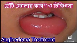 ঠোঁট ফোলার কারণ | ঠোঁট ফোলা কমানোর উপায় | Angioedema Treatment screenshot 5