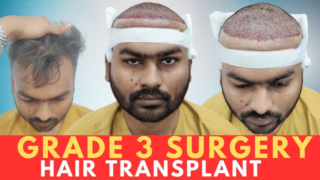 Hair transplant in jabalpur Best hair transplant results jabalpur YouTube
