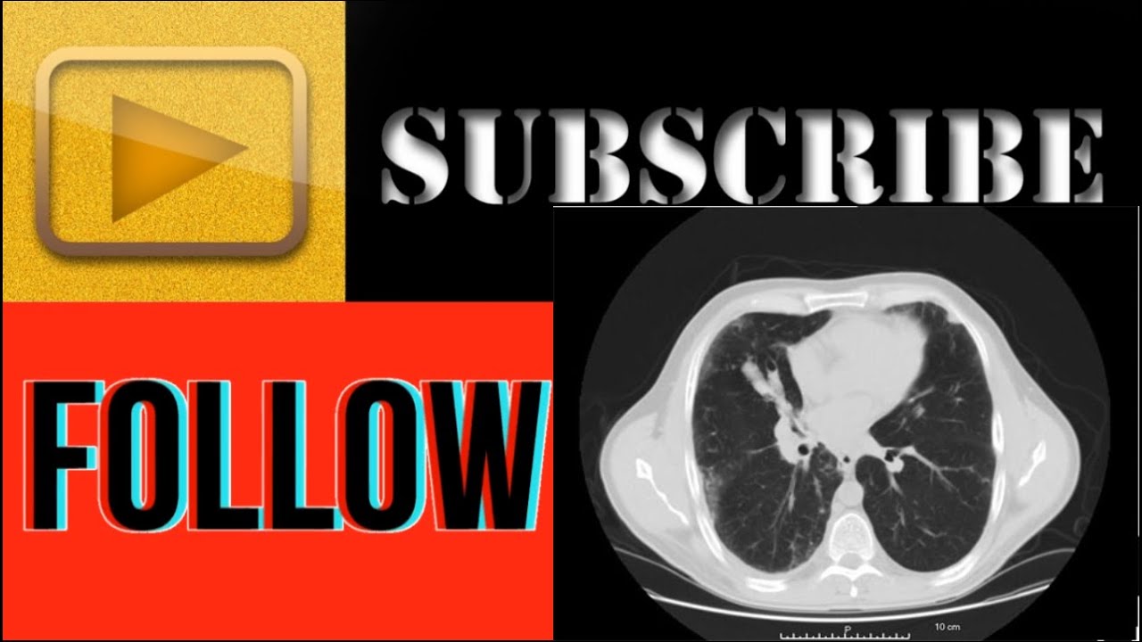 CT SCAN Hitachi Scenaria 128 slice: Actual Planning Chest plain - YouTube