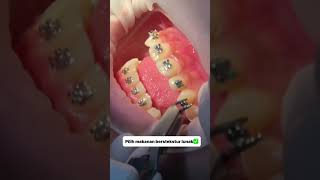 tips mengurangi rasa sakit setelah pakai behel gigi  #doktergigiterdekatsurabaya