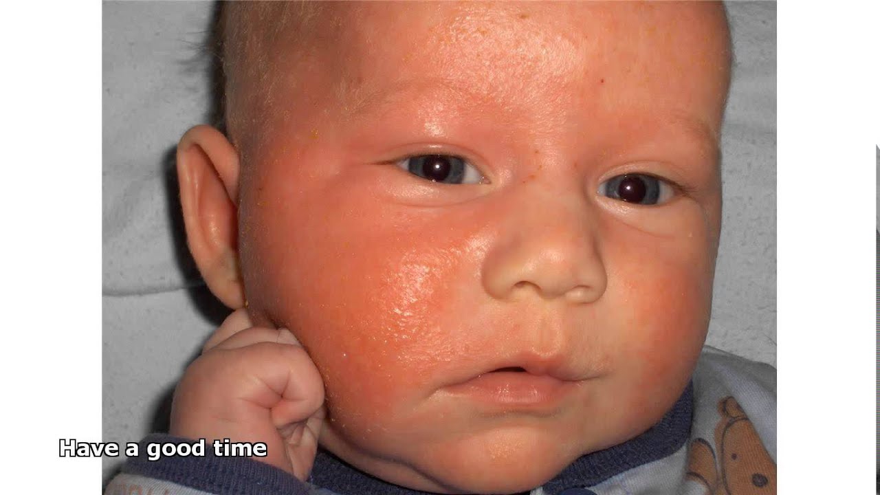 infant eczema