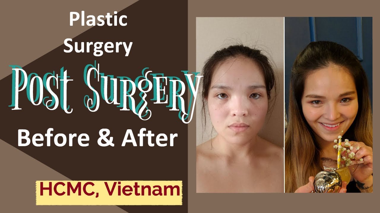 Plastic Surgery in HCMC, Vietnam Part 3 PostSurgery YouTube