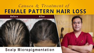 Female Pattern Hair Loss | Causes & Treatment (in 10 minutes)