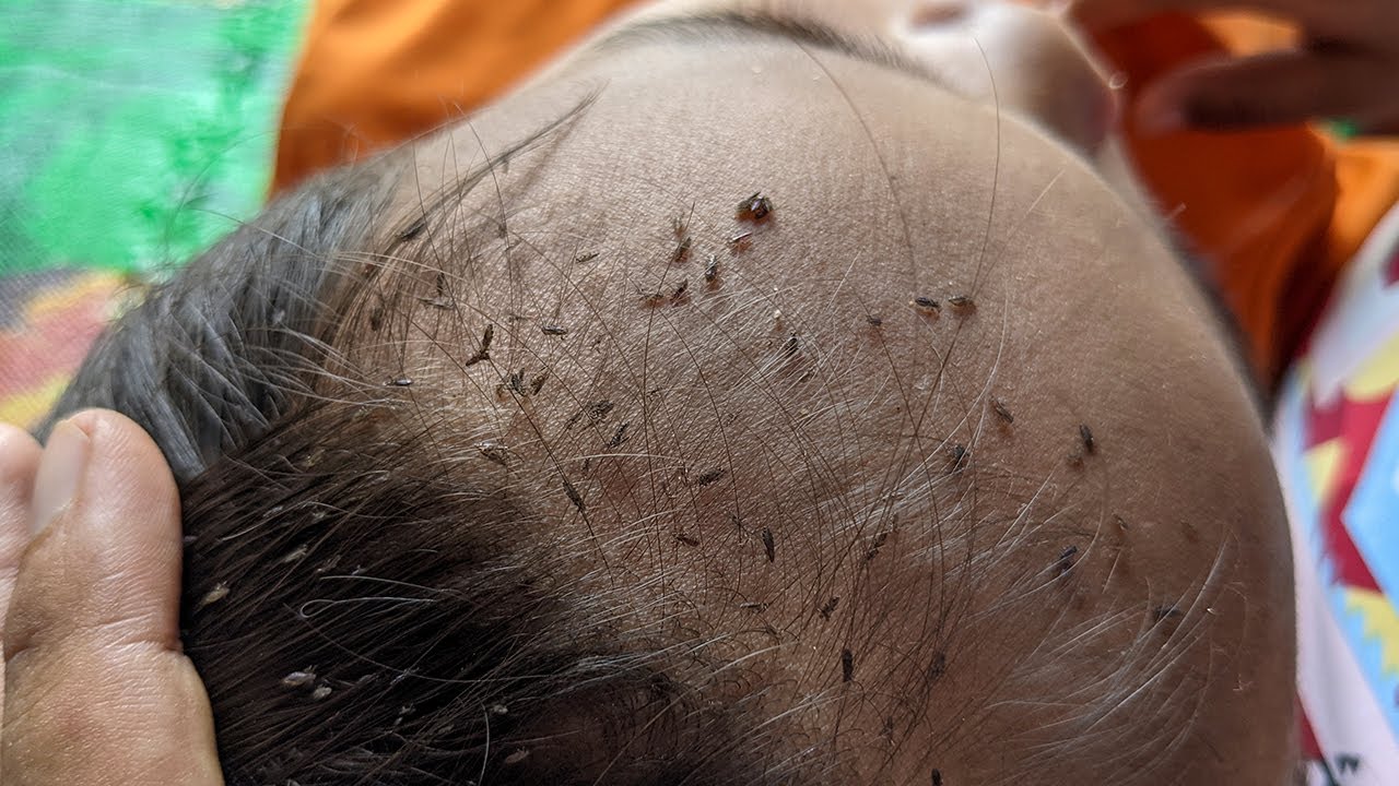 Getting out all lice from short hair How to get rid of lice from