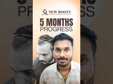 Receding Hairline Restoration | Hair Transplant in Siliguri #hairlinerestoration #viral #shorts