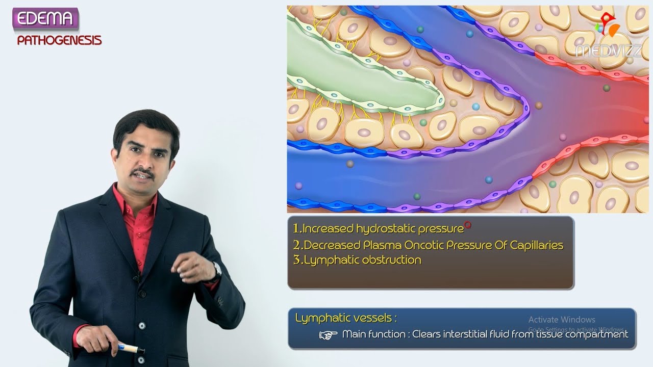 2.Edema Pathogenesis - Hemodynamic pathology Fmge & Neet PG