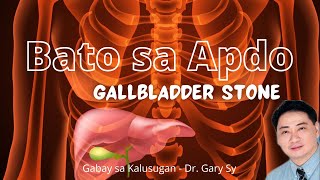 Gallbladder Stone  Dr. Gary Sy