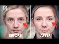 Eye bag removal in korea  undereye fat repositioning  seoul guide medical