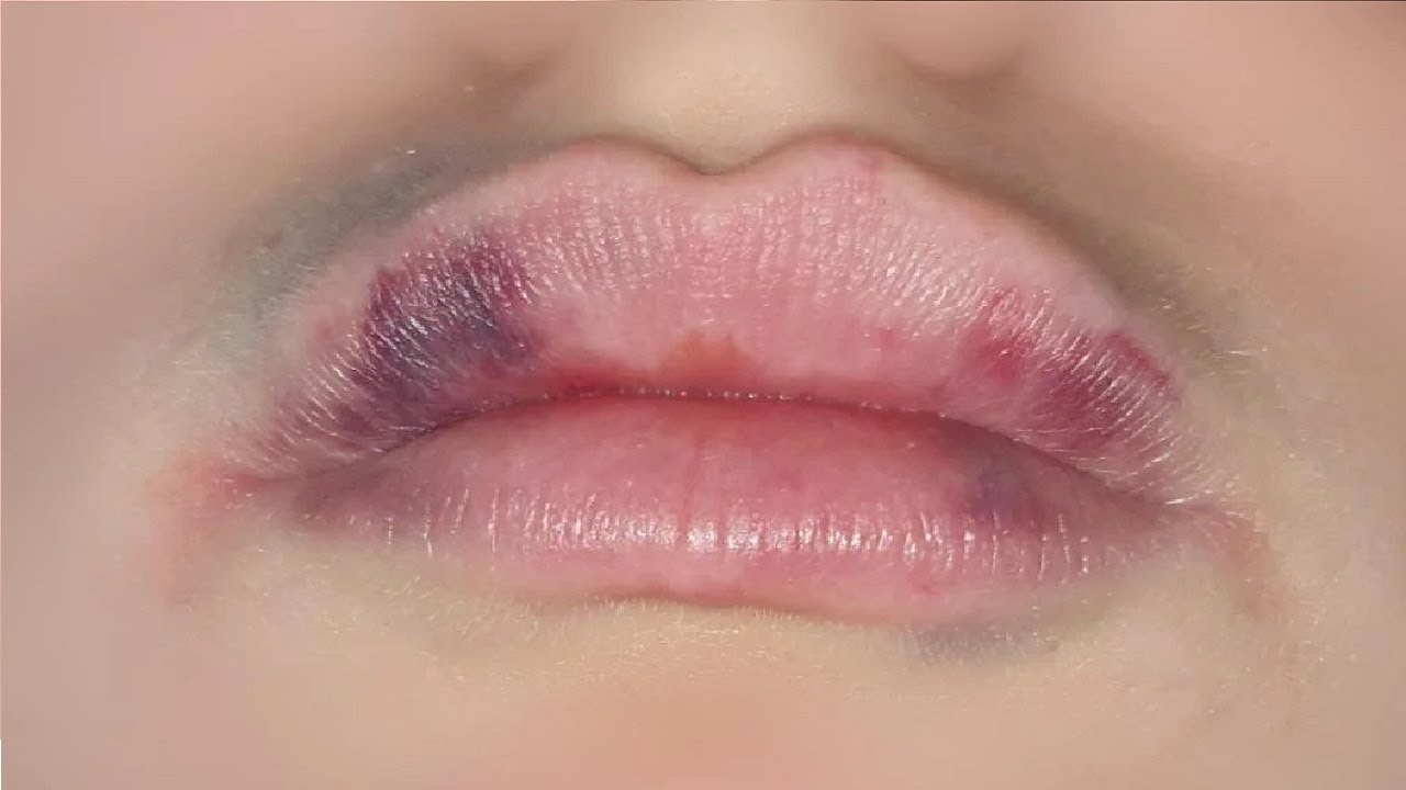 how-to-get-rid-of-bruised-lips-from-suction-fast-and-easy-youtube