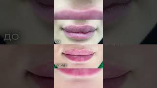 Желаете убрать «гиалуроновые усы» и комочки? Ждем вас в MED YU MED! #губы #комочки