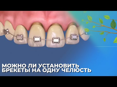 Можно ли установить брекеты на одну челюсть ☘️