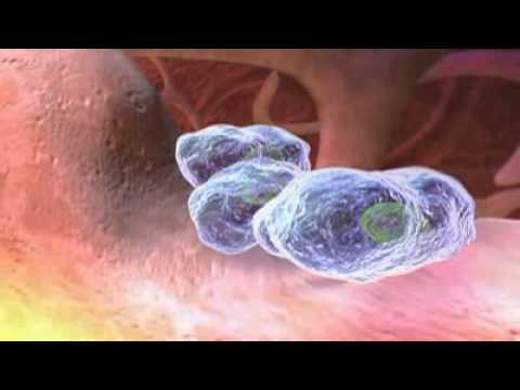 Vidéo: Sarcome Synovial - Causes, Symptômes, Pronostic, Traitement