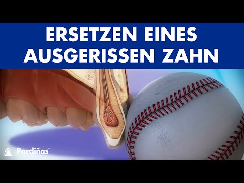 Video: Wo kann man einen avulsierten Zahn aufbewahren?