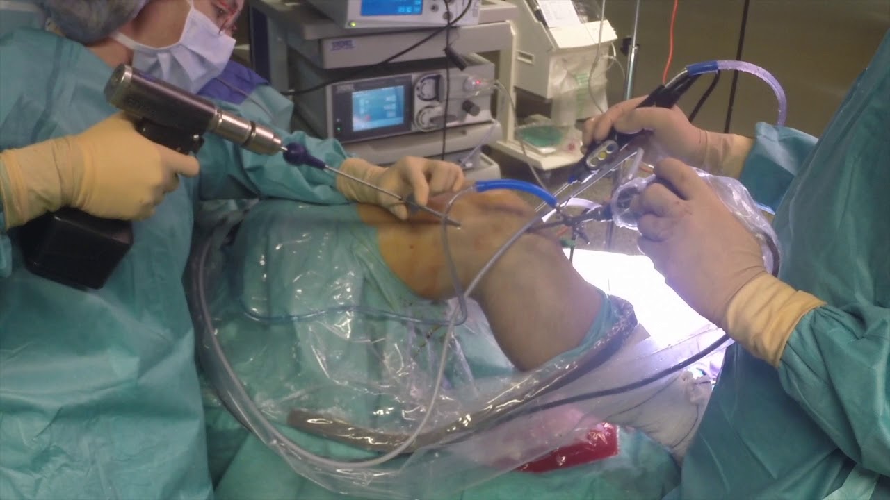 La chirurgie arthroscopique du Ligament Croisé Antérieur (LCA)