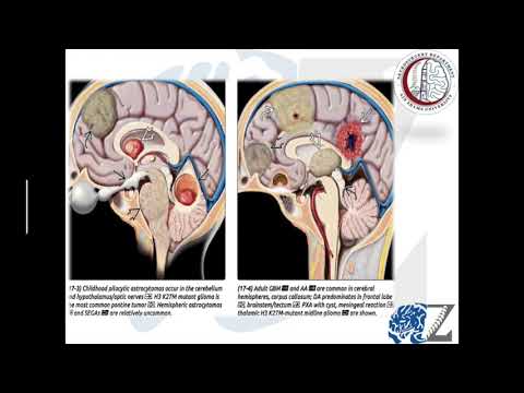 Brain Tumours (3):   Gliomas (1)   أورام المخ الدبقية/النجمية