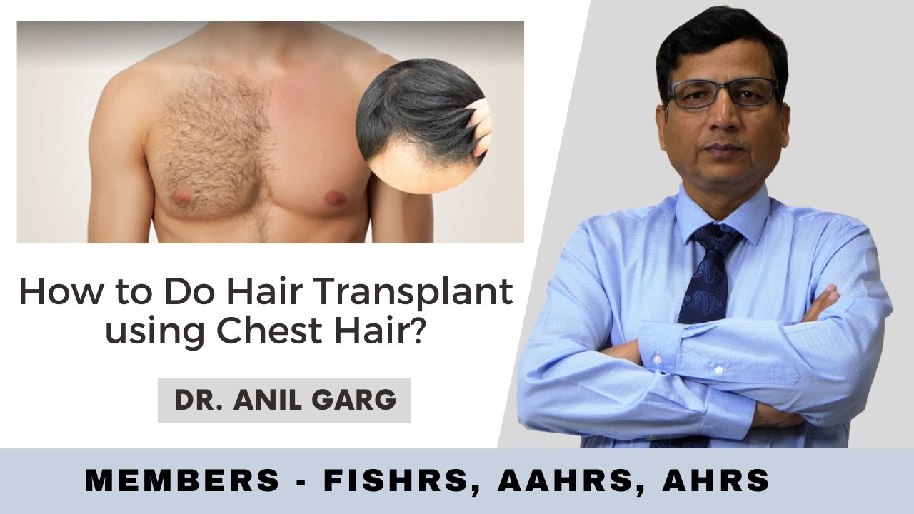 How to Do Hair Transplant using Chest Hair? Hair Transplant Dr