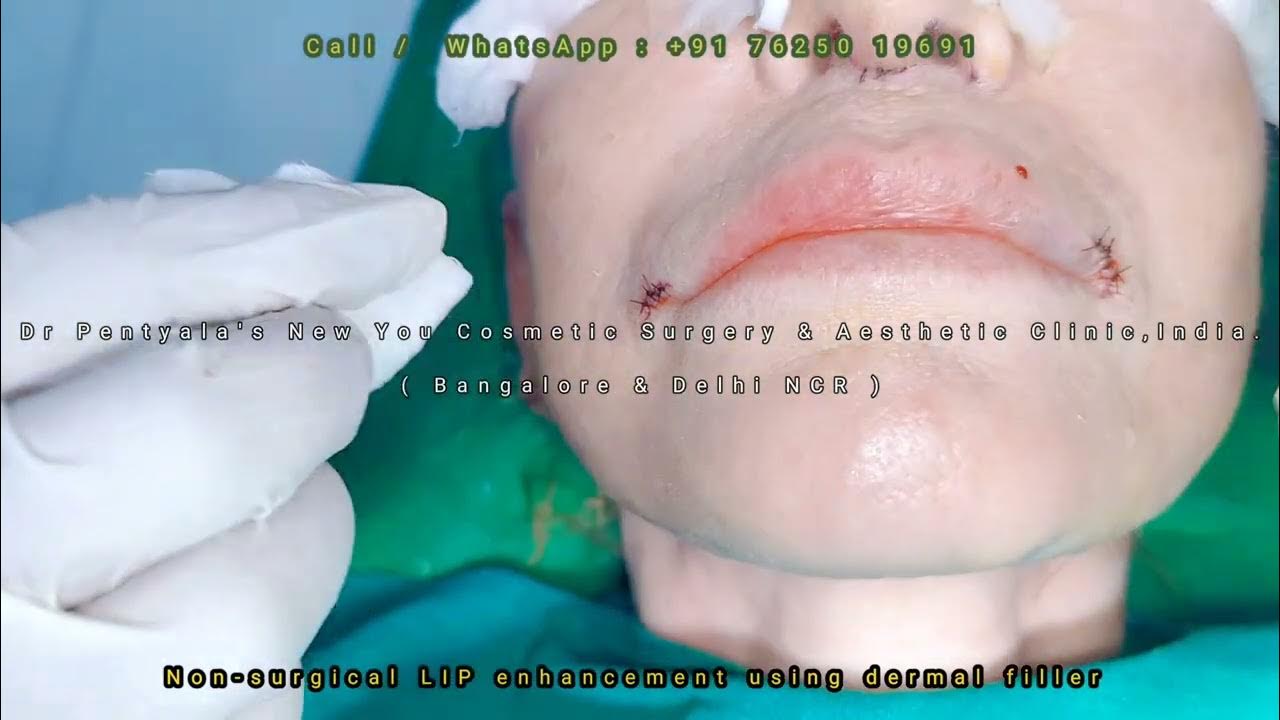 Usa patient beautiful lip fillers transformation dermal fillers dr