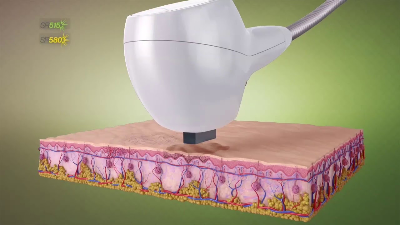 Venus Versa™ Skin Rejuvenation Treatments - YouTube
