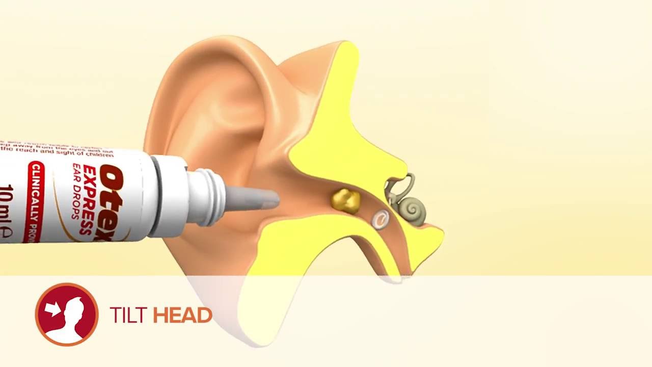 How To Use Otex Express Ear Drops - Youtube