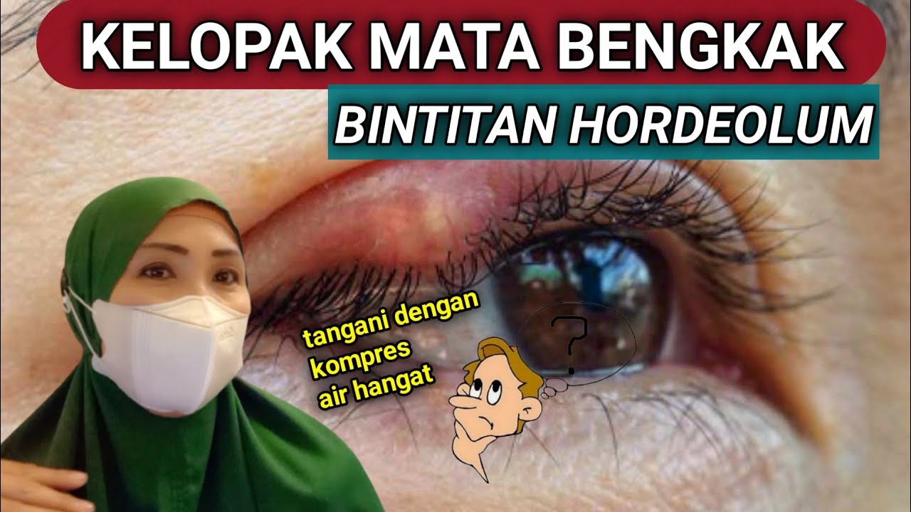 BENJOLAN DI KELOPAK MATA HORDEOLUM BINTITAN TIMBILAN - TIDAK HARUS