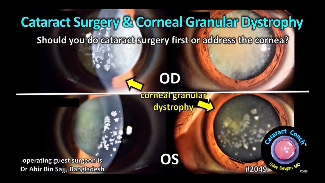 cataractcoach-2049-corneal-granular-dystrophy-cataract-surgery