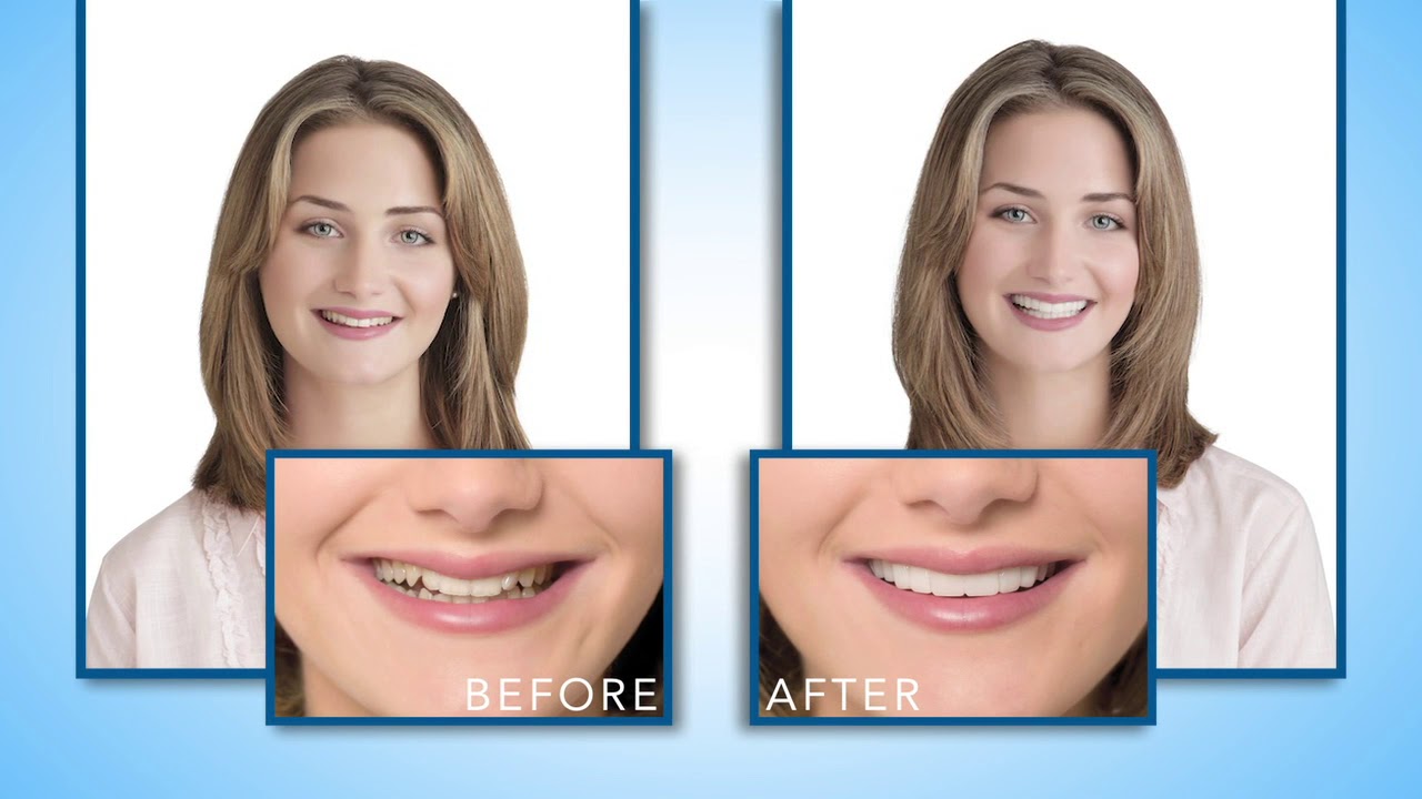 Snap-On Smile Veneers In Oak Park, IL | Town & Country Dental