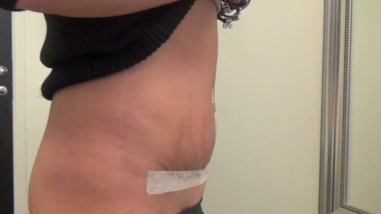 Bukplastik 230 g efter 10 dagar på Primakliniken Plastikoperationer