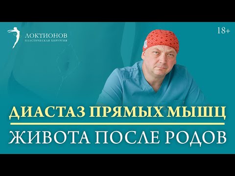Как беременность влияет на мышцы пресса? / Когда необходима пластика? /18+