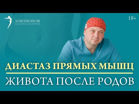 Как беременность влияет на мышцы пресса? / Когда необходима пластика? /18+