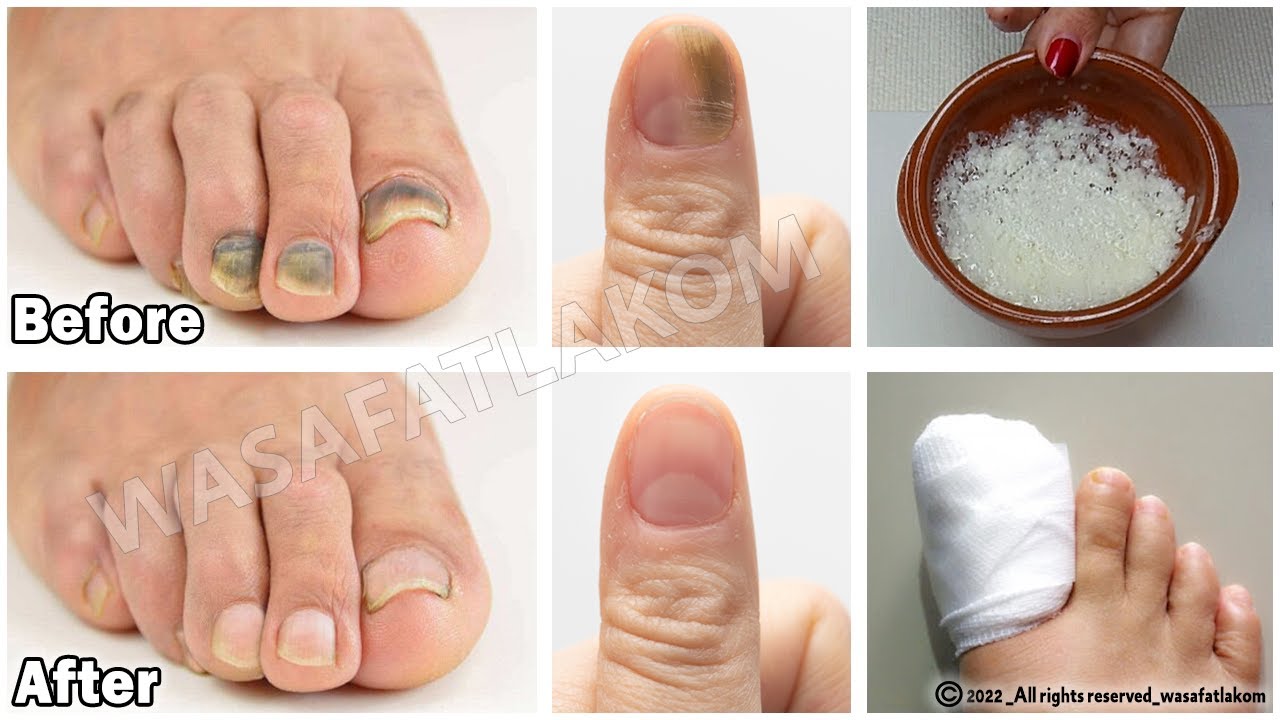 Dr. Cole's Nail Fungus Salt