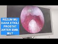 Rezum mu Daha Etkili Prostat Arter Embolizasyonu mu?