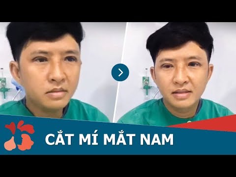 Cắt mí mắt cho nam giới bằng công nghệ Plasma Cắt mí mắt cho nam giới bằng công nghệ Plasma