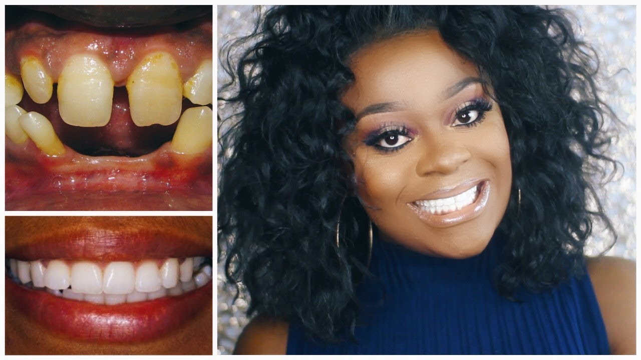 HOW I GOT THE PERFECT TEETH WITHOUT BRACES | NO MORE GAP ...