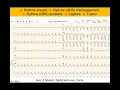 Tachycardie  qrs larges quiz ecg dr taboulet