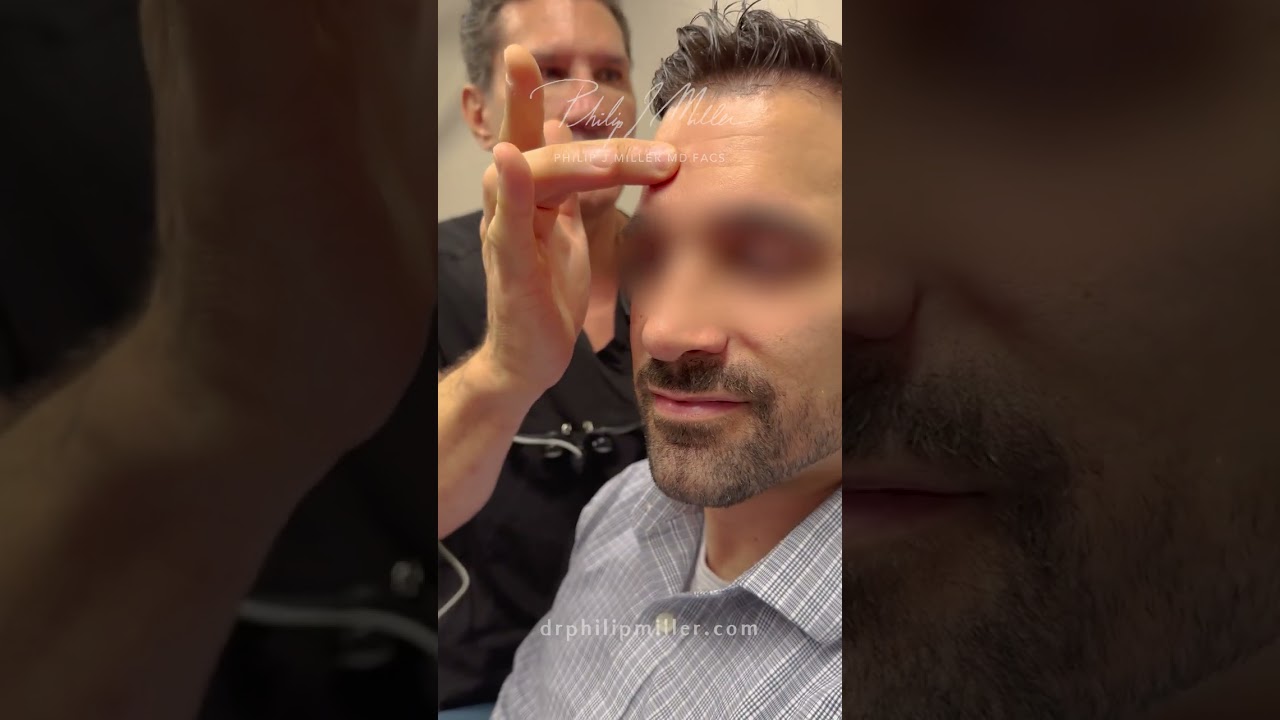 2 Months Post Op Tiplasty! Rotating a over-projected nose tip!
