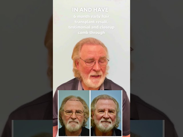 6 month early hair transplant result, testimonial, comb through video #hairtransplant