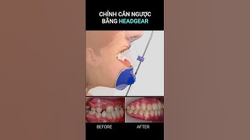 Chỉnh răng cắn ngược bằng khí cụ Facemask #braces #orthodontics