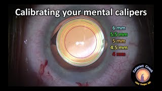 calibrating your mental calipers for capsulorhexis size in cataract surgery