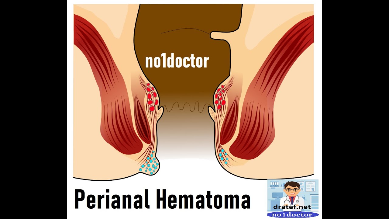 Perianal Hematoma /Piles /Hemorrhoids /Fissure /Perianal Fistula /Perianal Abscess/External Piles