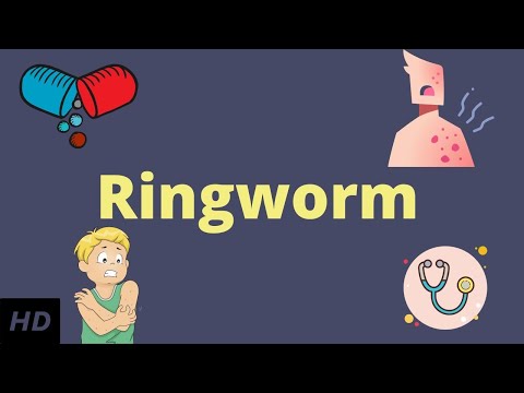 Video: Ringworm On Foot: Simptomi, Zdravljenje In Preprečevanje
