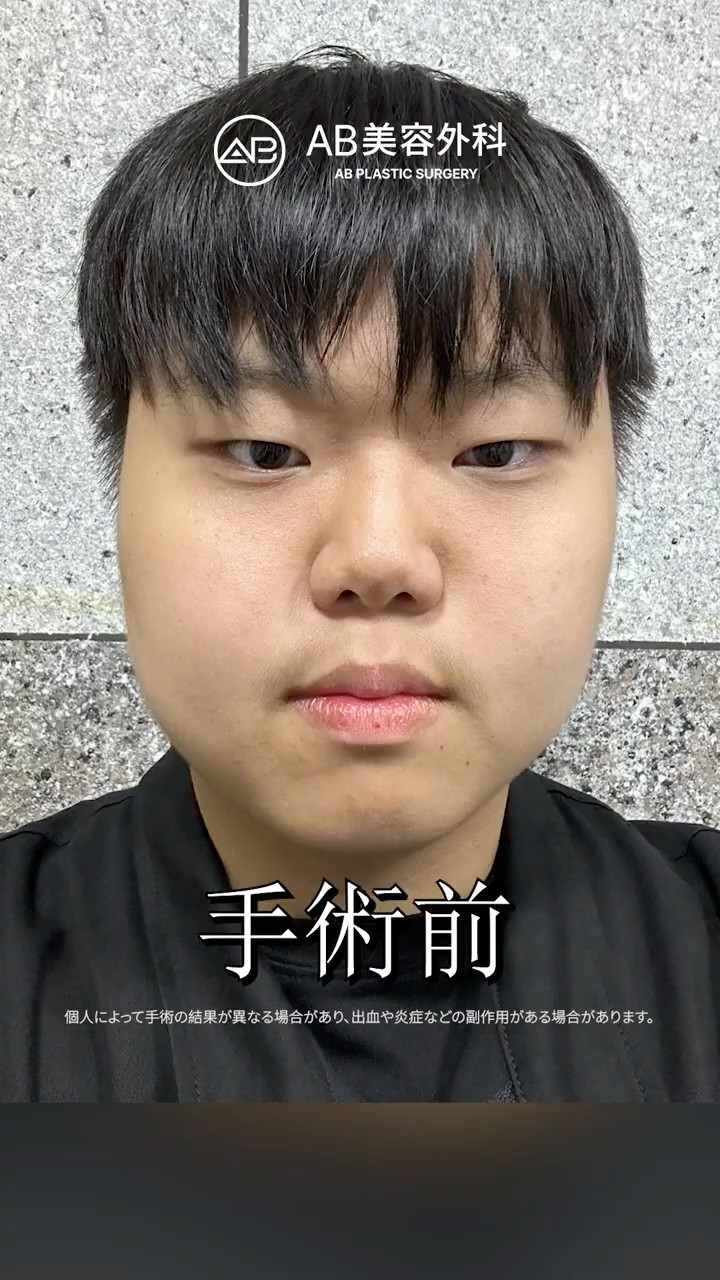 目整形・鼻整形でさらにイケメンに✨ #Shorts