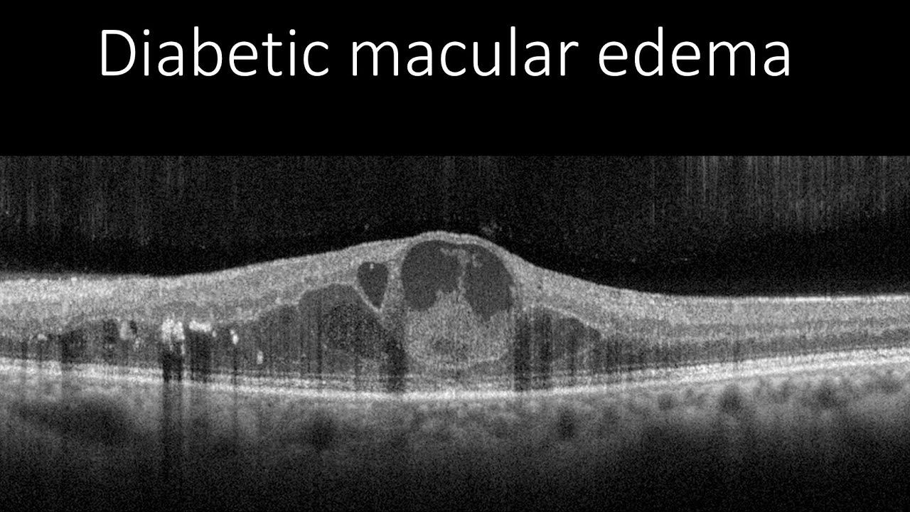 diabetic macular edema