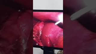 The Cystohepatic Mesentery and Cystic Duct Exploration During Laparoscopic Cholecystectomy