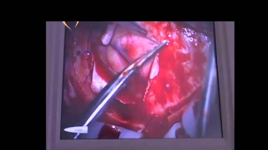 Лечение опухоли головного мозга в Израиле - интервью с профессором Цви Рам