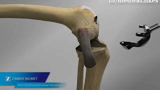 Anterior Approach & Dual Mobility (Animated)