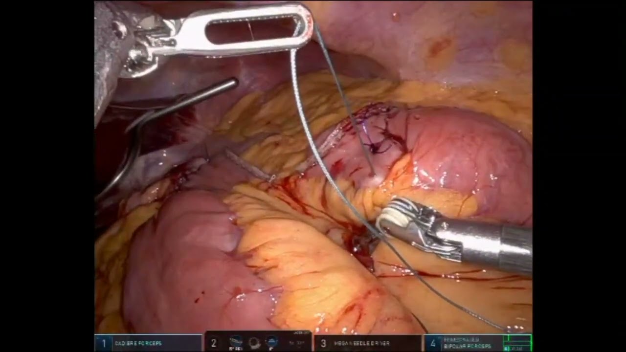 Narrated Gastric Bypass- Handsewn GJ 39 mins