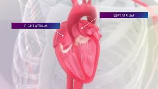 Left Atrial Appendage Occluders Reduce Risk of Stroke in AFib Patients