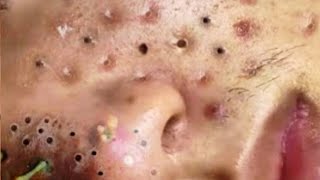 Soothing Blackhead Extraction ASMR Compilation PART 3