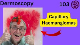 The Dermoscopy of Capillary Haemangiomas
