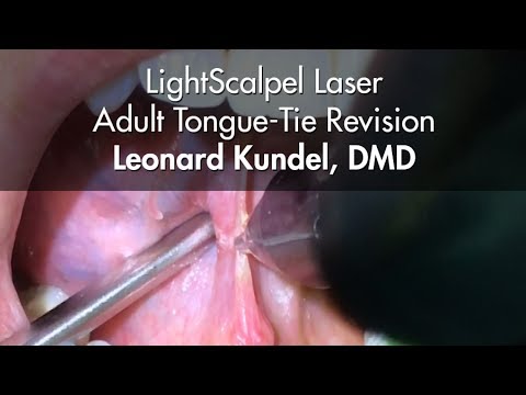 LightScalpel Laser Tongue-Tie Release - Leonard Kundel, DMD